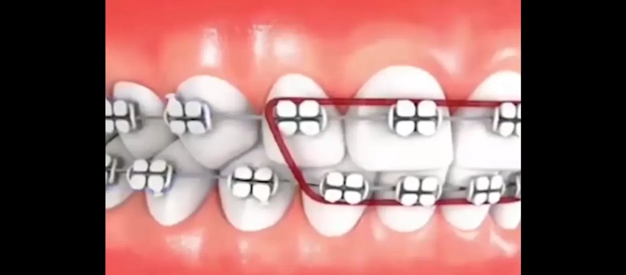 I tako bravice ravnaju zube | GIF